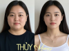 Thon gọn mặt, nọng cằm bằng Ultharapy Tại Phú Nhuận