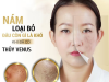 BAO LÂU SẼ HẾT THÂM SAU KHI BẮN LASER TRỊ NÁM