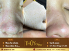 ĐIỀU TRỊ MỤN ĐẦU ĐEN TẠI SPA | ĐỊA CHỈ TRỊ MỤN HIỆU QUẢ AN TOÀN HỒ CHÍ MINH