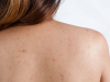 HIỆU QUẢ TRỊ VIÊM NANG LÔNG BẰNG LASER | TRỊ VIÊM NANG LÔNG GIÁ RẺ TẠI PHÚ NHUẬN