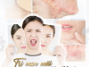 MỤN ẨN TRÊN TRÁN ĐIỀU TRỊ NHƯ THẾ NÀO? 