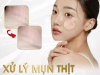 TRỊ MỤN THỊT QUANH MẮT TẠI SPA | ĐỊA CHỈ TRỊ MỤN THỊT BẰNG LASER HIỆN ĐẠI