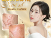 TRỊ SẸO RỖ MẤT THỜI GIAN BAO LÂU | TRỊ SẸO RỖ BẰNG LASER CÓ HIỆU QUẢ KHÔNG