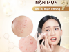 VÌ SAO NÊN ĐẾN SPA NẶN MỤN THAY VÌ Ở NHÀ