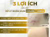 Lợi ích của việc xử lý nhân mụn chuẩn y khoa