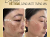 DA SẠCH HẾT NÁM – CĂNG MƯỚT TRẮNG MỊN