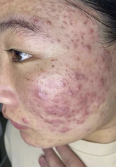 Điều trị mụn tuổi dậy thì