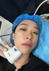 Thon gọn cằm bằng công nghệ Hifu Ultherapy