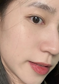 Điều trị mụn tuổi dậy thì 