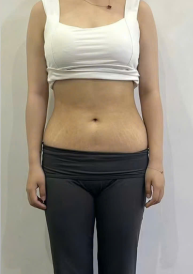 Giảm béo trị rạn da sau sinh