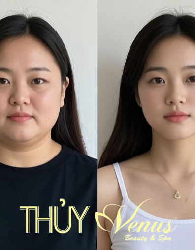 Thon gọn mặt, nọng cằm bằng Ultharapy Tại Phú Nhuận