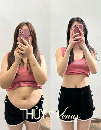 GIẢM BÉO CÔNG NGHỆ VACUUM