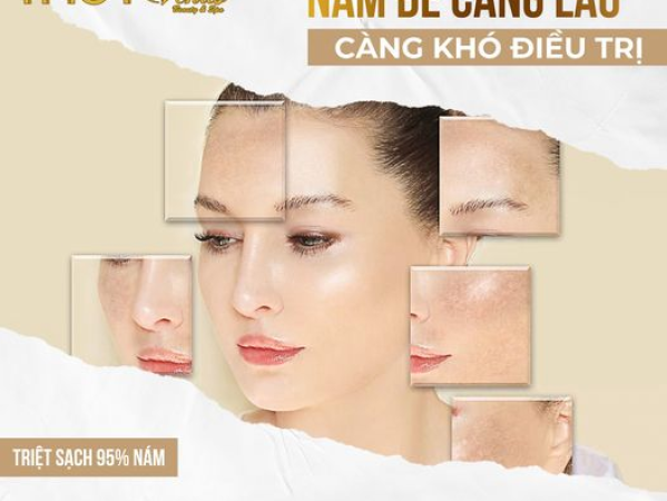 CÁC CẤP ĐỘ NÁM DA VÀ LƯU Ý KHI ĐIỀU TRỊ NÁM BẰNG LASER | ĐỊA CHỈ TRỊ NÁM HIỆU QUẢ PHÚ NHUẬN