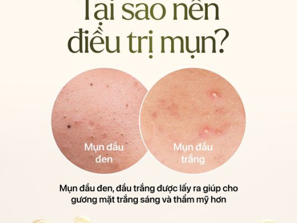 CÁCH ĐIỀU TRỊ MỤN ĐẦU ĐEN AN TOÀN | ĐỊA CHỈ NẶN MỤN ĐẦU ĐEN GIÁ RẺ