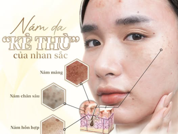GIỚI THIỆU NHỮNG CÔNG NGHỆ TRỊ NÁM HIỆN ĐẠI TẠI SPA  