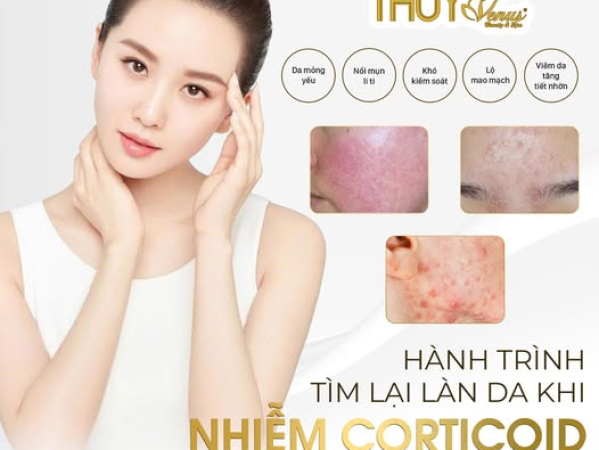 HÀNH TRÌNH TÌM LẠI LÀN DA SAU KHI NHIỄM CORTICOID | CHỮA DA NHIỄM CORTICOID TẠI SPA