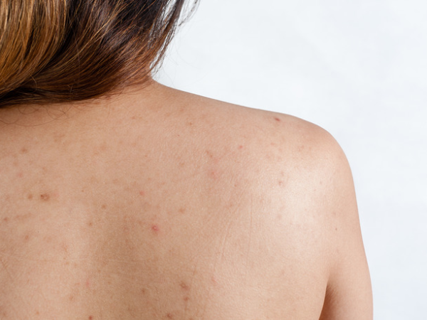PHƯƠNG PHÁP ĐIỀU TRỊ VIÊM NANG LÔNG HIỆN ĐẠI TẠI SPA QUẬN PHÚ NHUẬN