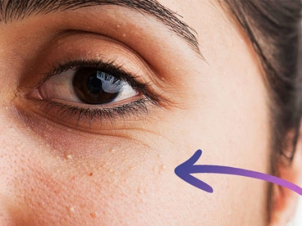 PHƯƠNG PHÁP ĐỐT MỤN THỊT TỐT NHẤT HIỆN NAY | SPA ĐỐT MỤN THỊT HIỆU QUẢ GIÁ RẺ