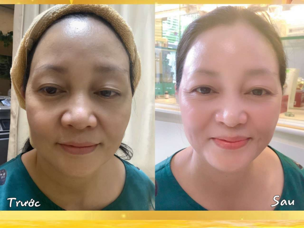 Tại TMV Thủy Venus, rất nhiều phụ nữ đang tham gia vào một liệu trình trẻ hóa da vùng mắt được truyền miệng sẽ mang lại kết quả ngay sau 5 phút