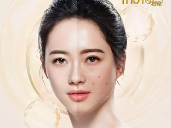 TIÊM MESO CÓ TRỊ MỤN KHÔNG? HIỆU QUẢ PHƯƠNG PHÁP TIÊM MESO TRỊ MỤN
