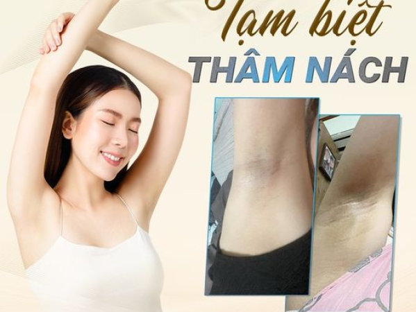 TIPS TRỊ THÂM NÁCH TẠI NHÀ | CÔNG NGHỆ TRỊ THÂM NÁCH TIÊN TIẾN TẠI SPA