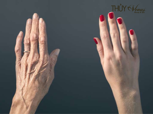 TRẺ HÓA DA TRỊ NHĂN BÀN TAY CÓ NÊN KHÔNG? Nguyên nhân có nếp nhăn trên tay