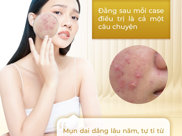 TRỊ MỤN NỘI TIẾT HIỆU QUẢ TẠI SPA PHÚ NHUẬN | ĐỊA CHỈ TRỊ MỤN GIÁ RẺ
