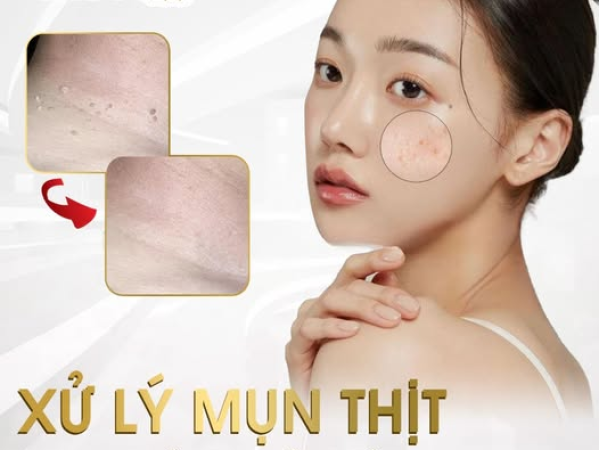 TRỊ MỤN THỊT QUANH MẮT TẠI SPA | ĐỊA CHỈ TRỊ MỤN THỊT BẰNG LASER HIỆN ĐẠI