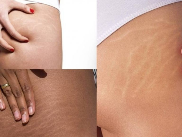 TRỊ RẠN DA TẠI THẢM MỸ VIỆN BẰNG LASER CÓ MẮC KHÔNG? | TRỊ RẠN DA TẠI THẢM MỸ VIỆN THỦY VENUS | TRỊ RẠN DA TẠI THẢM MỸ VIỆN PHÚ NHUẬN