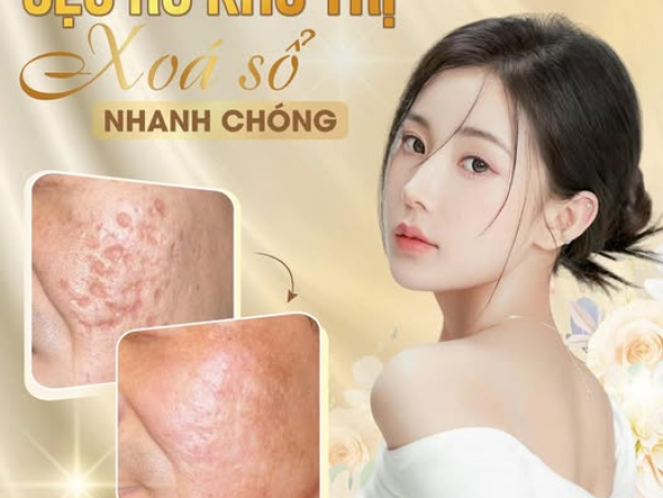 TRỊ SẸO RỖ MẤT THỜI GIAN BAO LÂU | TRỊ SẸO RỖ BẰNG LASER CÓ HIỆU QUẢ KHÔNG