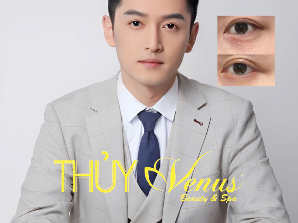 Điều trị nếp nhăn mắt nam giới