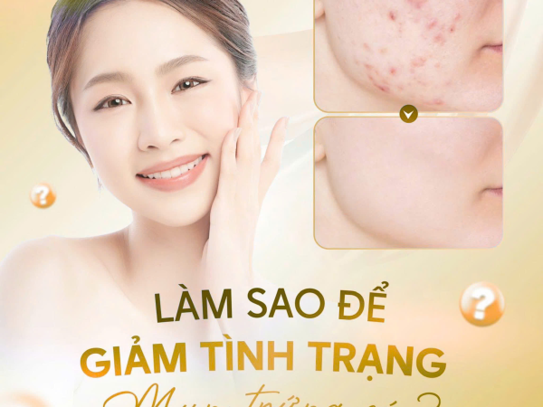 LÀM SAO ĐỂ GIẢM TÌNH TRẠNG MỤN TRỨNG CÁ?