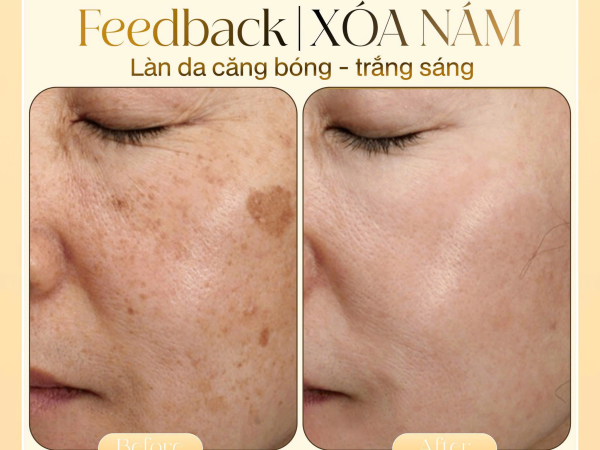 Xóa nám uy tín tại Thủy Venus