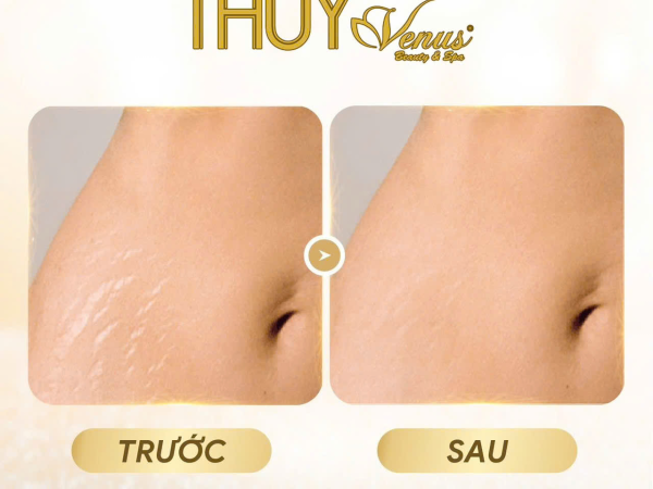 ✨ TỰ TIN DIỆN ĐẦM ÔM – TẠM BIỆT RẠN DA SAU SINH ✨