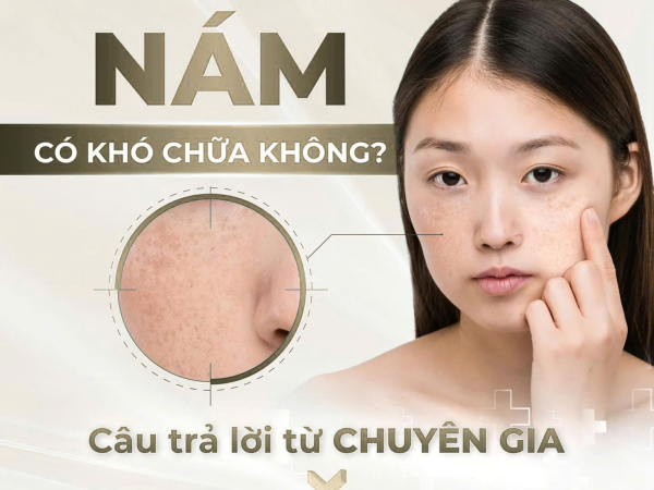 Nám có khó chữa không ? Thủy Venus sẽ giúp bạn trả lời câu hỏi này