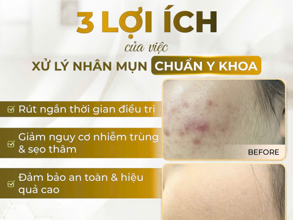 Lợi ích của việc xử lý nhân mụn chuẩn y khoa